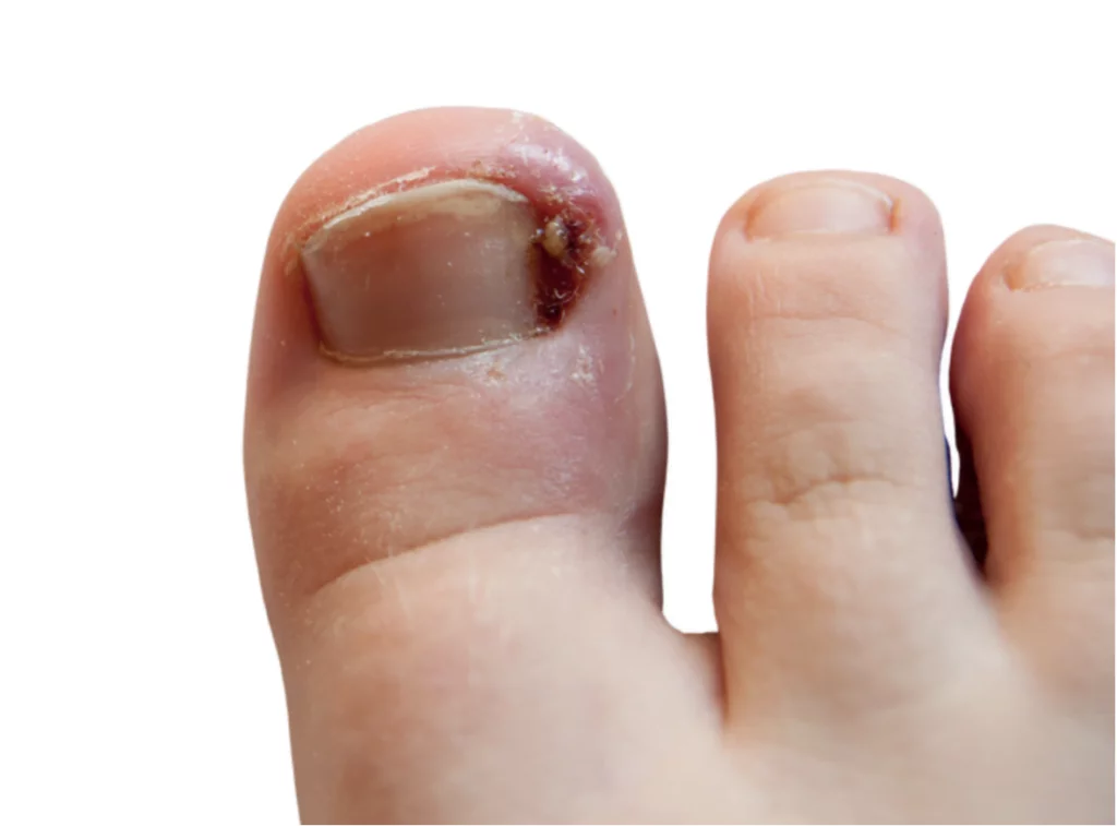 Ongle incarné sur un gros orteil