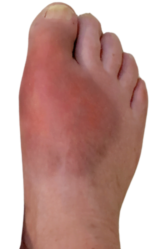 infection du pied