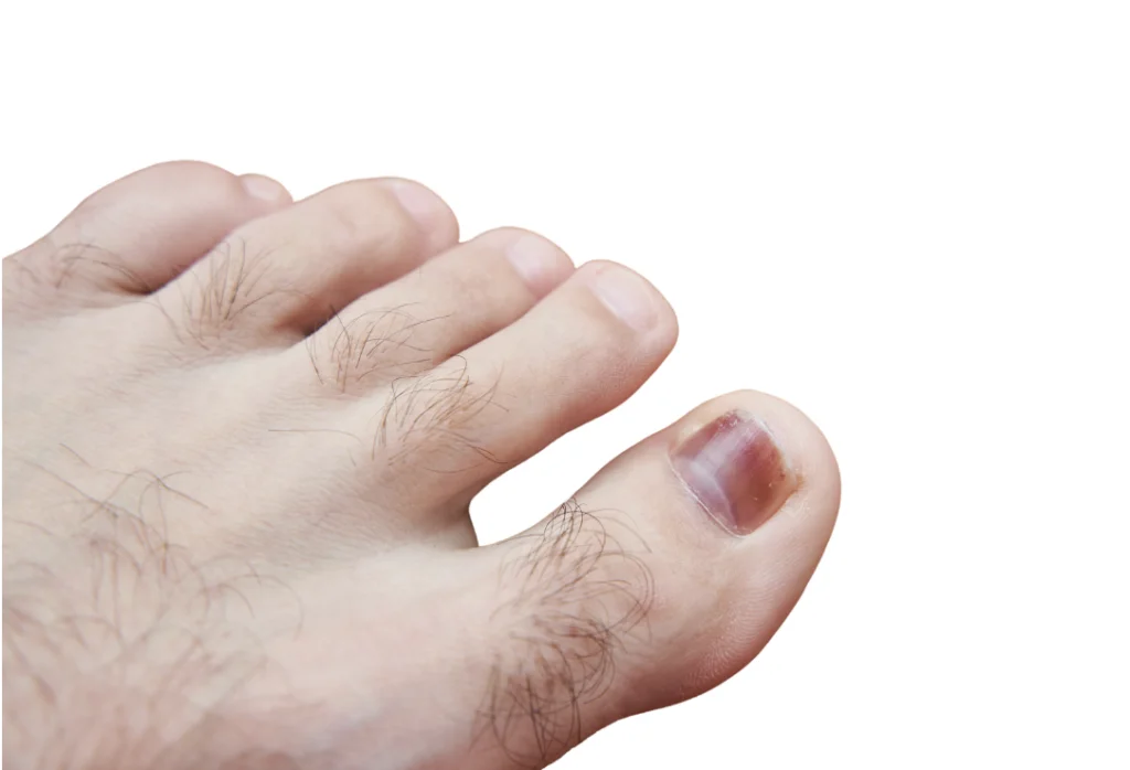 Ongle du gros orteil épais