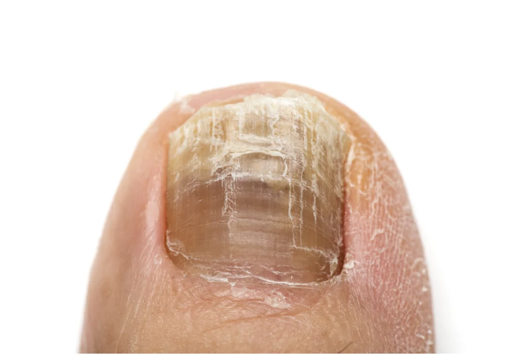 Champignons sur l'ongle d'une gros orteil